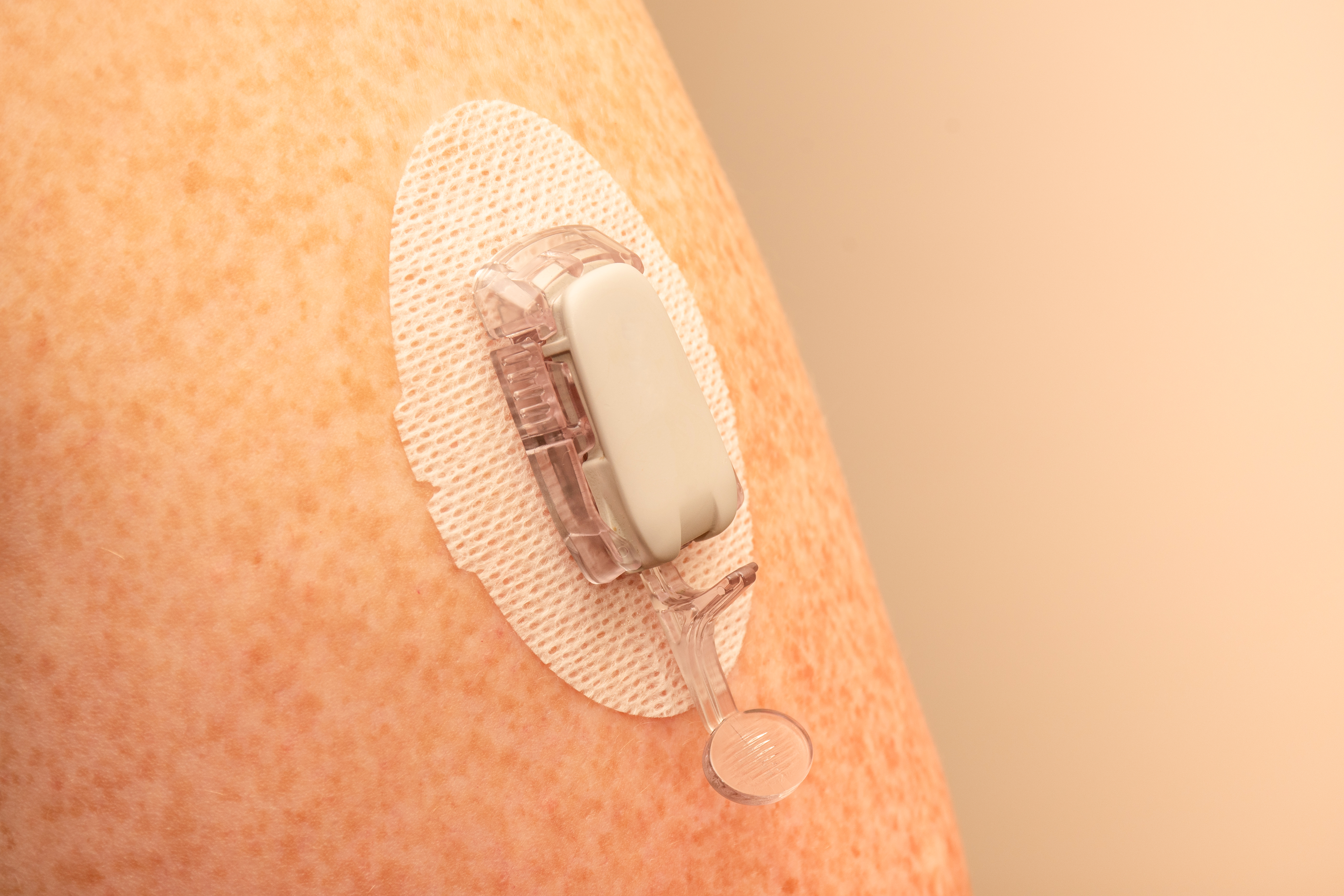 Developing Optimal Skin Contact Adhesives for Continuous Glucose Monitoring Devices